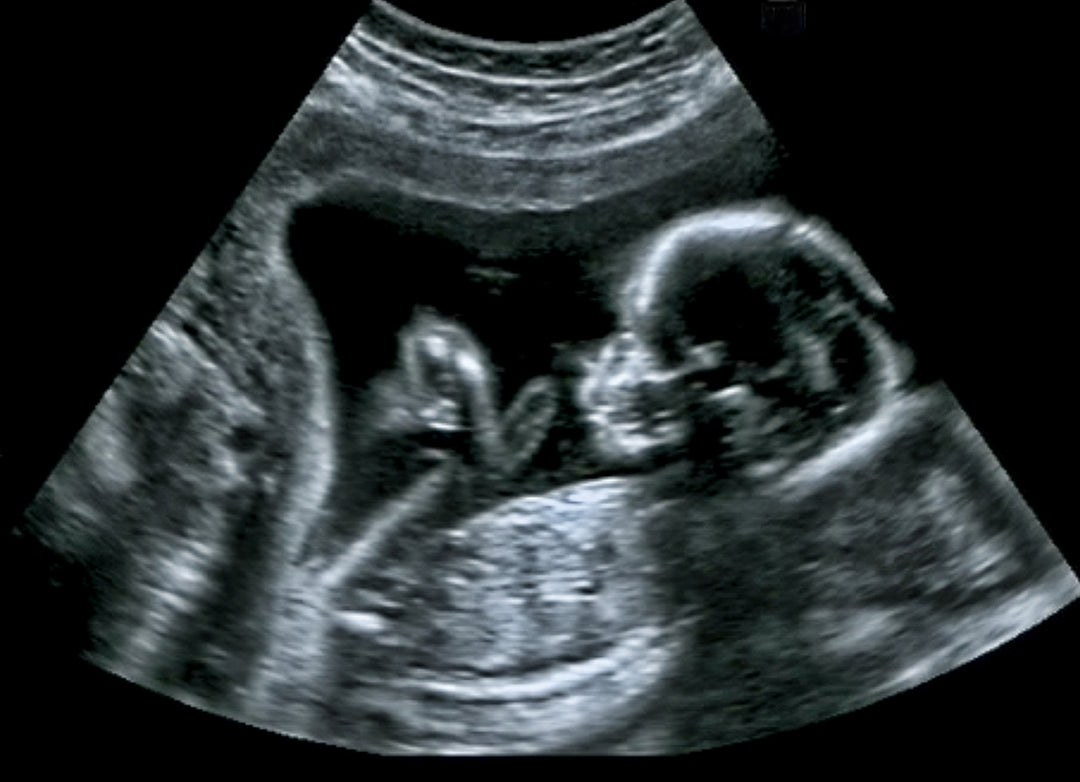 Limited Fetal Growth + AFI (2nd/3rd Trimester)