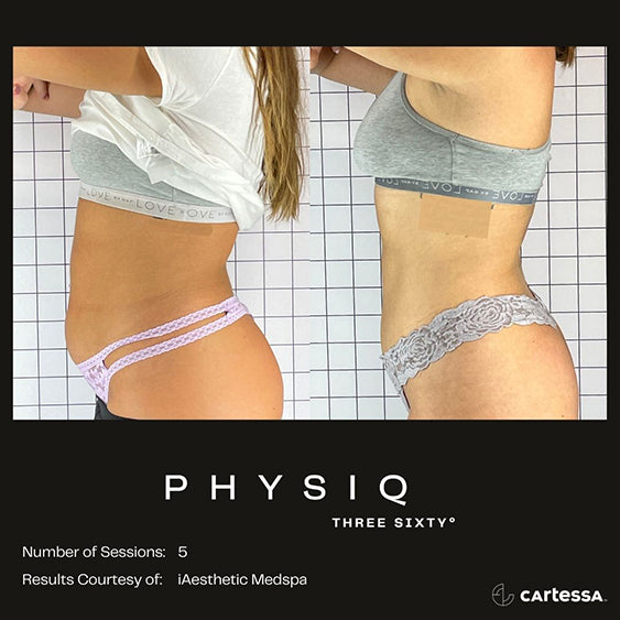 PHYSIQ 360 Body Contouring