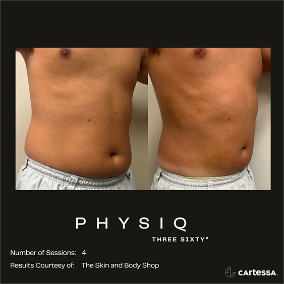 PHYSIQ 360 Body Contouring