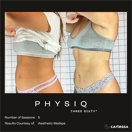 PHYSIQ 360 Body Contouring
