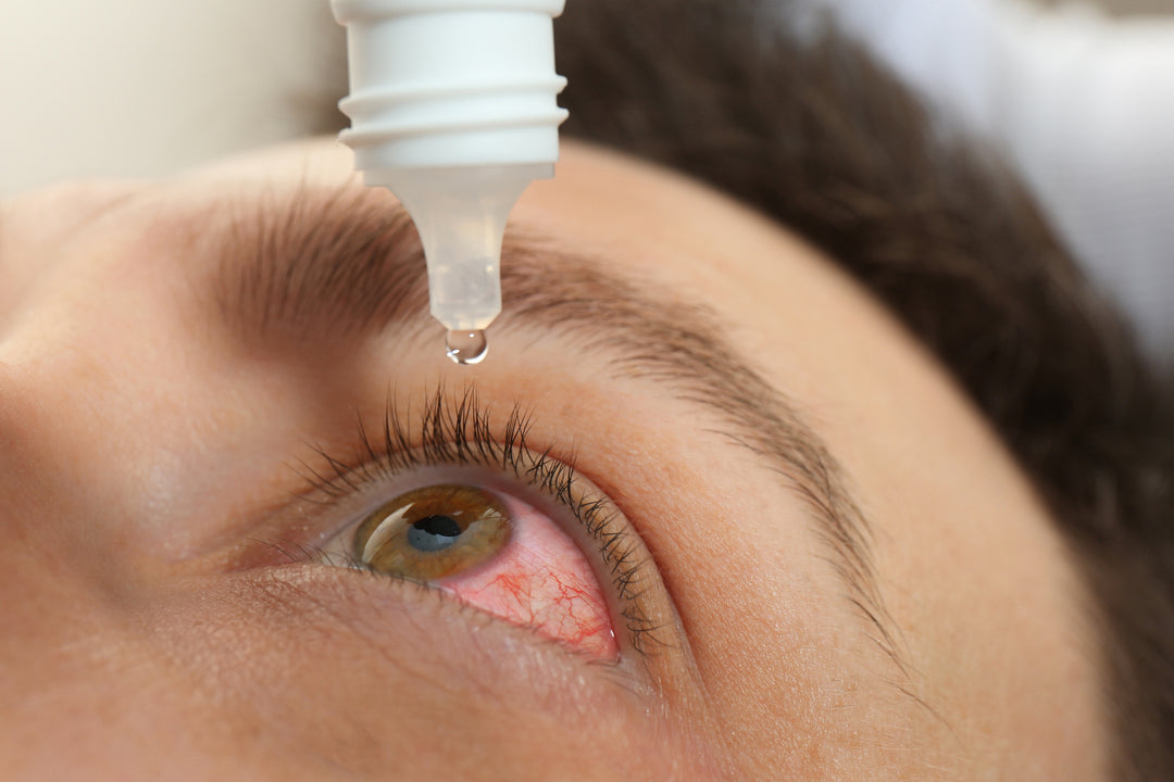 Dry Eye