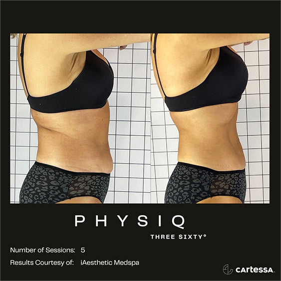PHYSIQ 360 Body Contouring